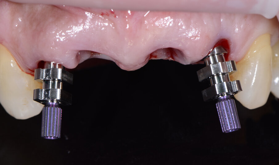 Fig. 32 - Transfert avvitati sugli impianti.