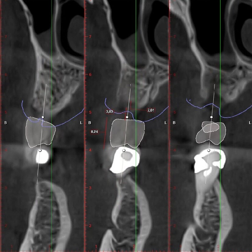 Fig. 4_Ceratura diagnostica elemento 2.5. Dimensione corono-apicale della corona congruente con elemento controlaterale 8,24 mm, tragitto trans-mucoso 3,03 mm, entità della rigenerazione ossea verticale necessaria 2,01 mm.