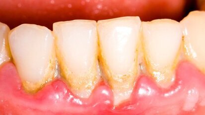 Mit Molekülen gegen Plaque Mit Molekülen gegen Plaque