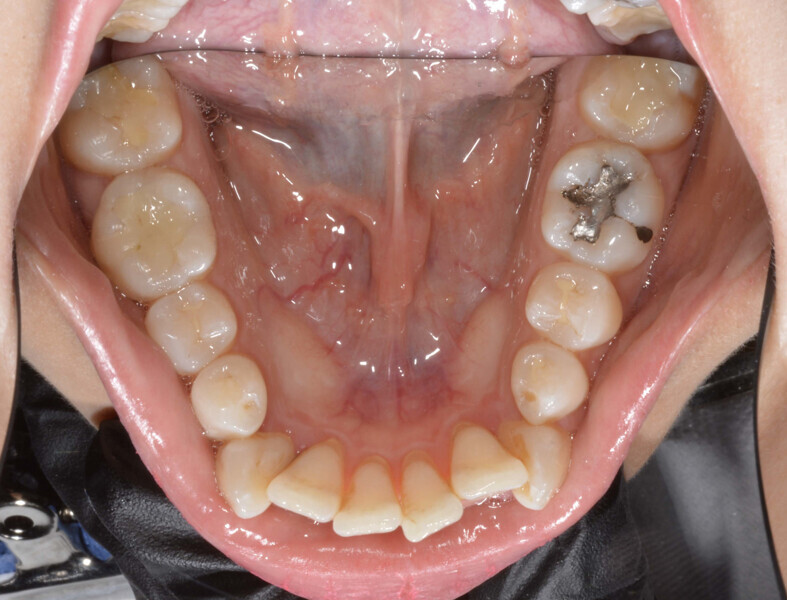 Fig. 3c: Initial occlusal photograph.