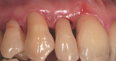 Zapobieganie głębokim chorobom przyzębia dzięki zastosowaniu lasera Er:YAG