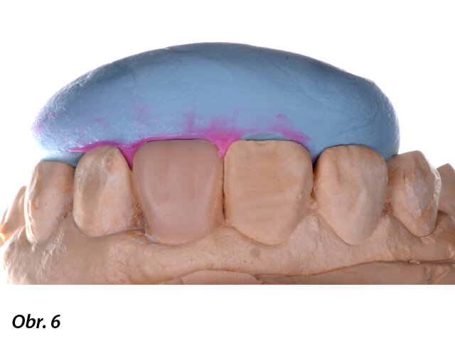 Wax-up umožňující vytvoření silikonového klíče.
