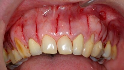 Corticotomies alvéolaires par Lasercision : Une procédure minimalement invasive dans le but d’accélérer les traitements orthodontiques chez l’adulte
