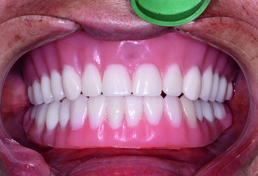 Fig. 16: Immediate dentures with soft relining.