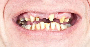 Arme Amerikanen hebben slechtere mondgezondheid