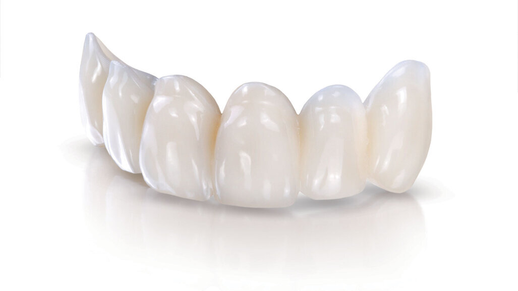 Rethinking provisionals: The many advantages of premade custom temporaries