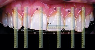 Cyfrowe projektowanie uśmiechu, przeniesienie projektu na model roboczy – część 2