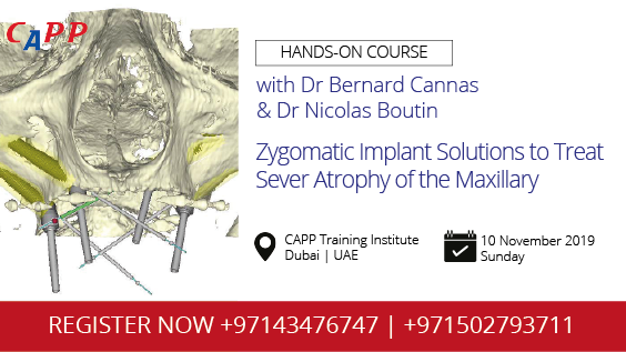 Zygomatic Implant Solutions to Treat Sever Atrophy of the Maxillary