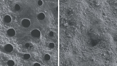 Hloubková obnova skloviny – zmírnění citlivosti zubu již po 1. použití, klinicky prokázáno