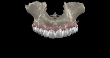 Transforming full-mouth rehabilitation: A case report on Smilecloud and digital workflows