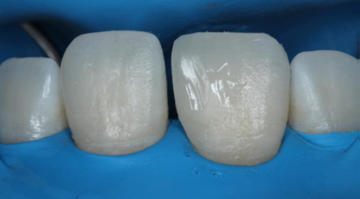 Fig. 11: Emergence profile of 2nd tooth