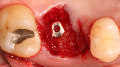 Digital peri-implant tissue healing