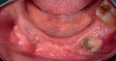 Osteonecrosi delle ossa mascellari (ONJ)