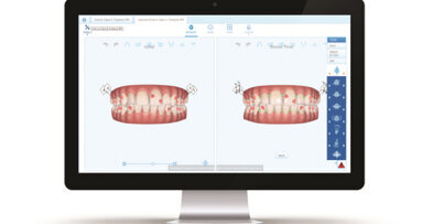 Align Technology expands digital platform with ClinCheck Pro 6.0 and In-Face Visualization