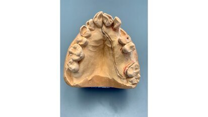 POM: een nieuwe speler op het terrein van uitneembare prothetische voorzieningen