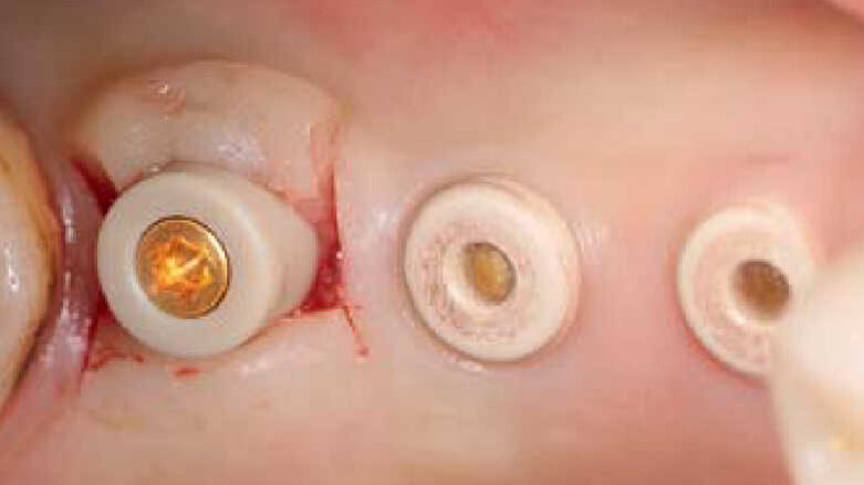 Piliers CAD/CAM individualisés sur implants en céramique