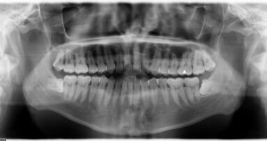 Ακτινογραφίες και καρκίνος του θυρεοειδή