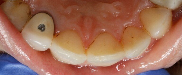 Fig. 4c - Controllo a sei mesi.
