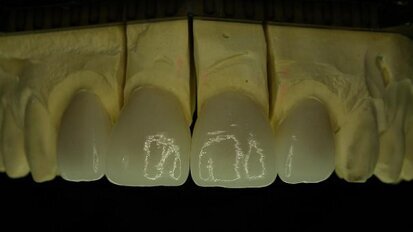 Lithium disilicate—An effective solution for aesthetically demanding indications