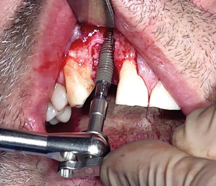Fig. 16 : Placement de l‘implant cylindroconique. 