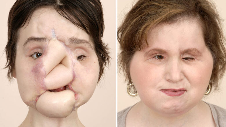 Young woman receives successful face transplant