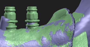 Comparison of guided and non-guided implant placement accuracy (Part 2)