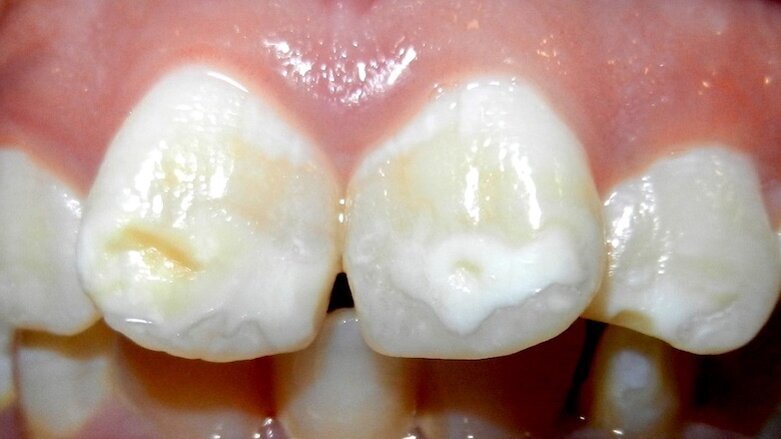 Colgate lanza un Advisory Board sobre mancha blanca en ortodoncia