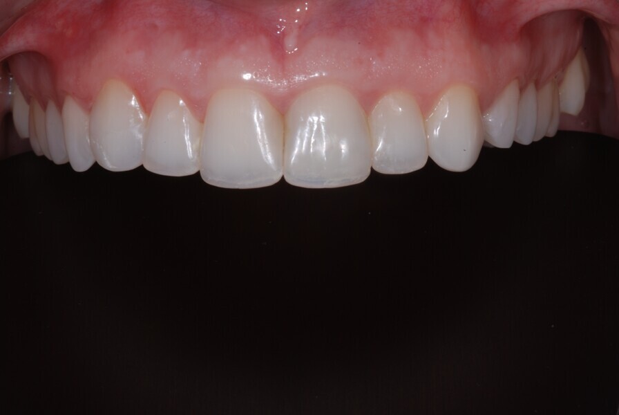 Fig. 18: Intra-oral maxillary frontal view after treatment