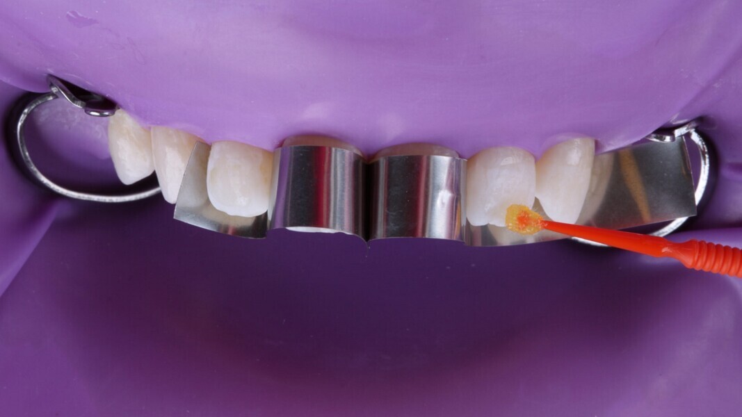 Fig. 9: Aanbrengen van 3M Scotchbond Universal Plus Adhesief. Masseer het adhesief 20 seconden in op het tandoppervlak, blaas lucht om de oplosmiddelen te laten verdampen en hard vervolgens 10 seconden uit met licht.