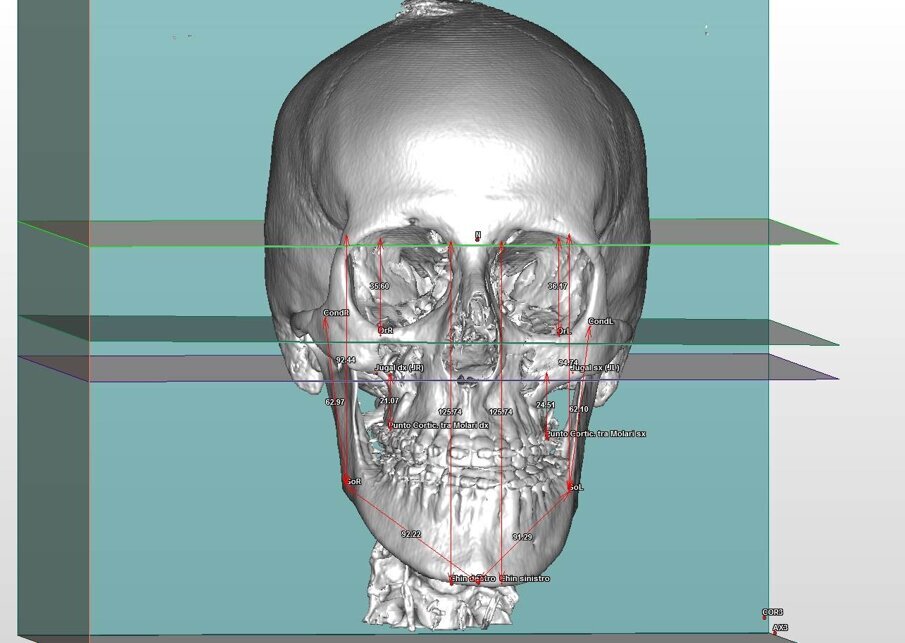 Fig. 3_Analisi della asimmetria scheletrica pre-chirurgica. 