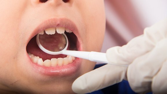 מחקר מגלה רמות כספיות שתן גבוהות בילדים עם סתימות אמלגם