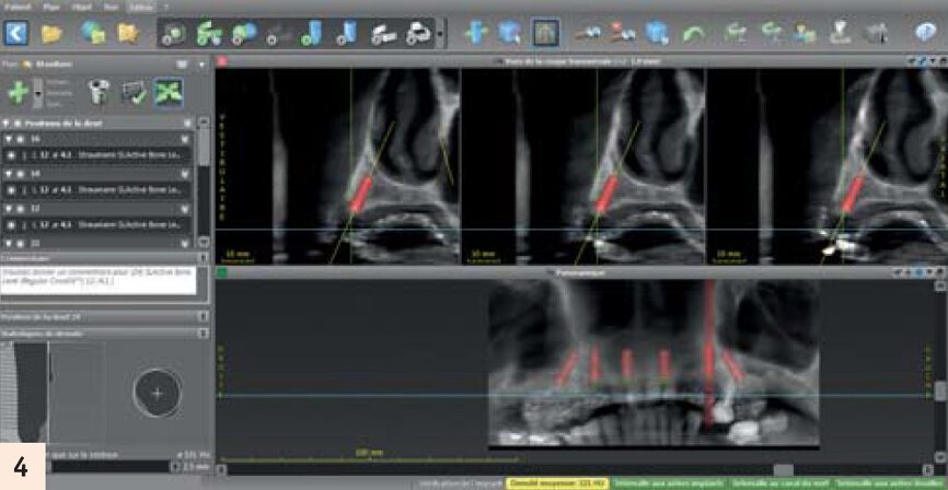 Planification sur le logiciel de planification CodiagnostiX après Cone Beam avec gouttière radio-opaque.
