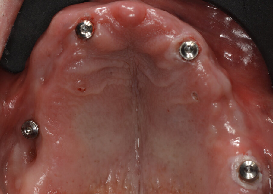 Fig. 14_Healing abutment per chirurgia one-stage.