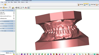 TC Cone Beam e scanner in ortognatodonzia: dalla diagnosi al manufatto