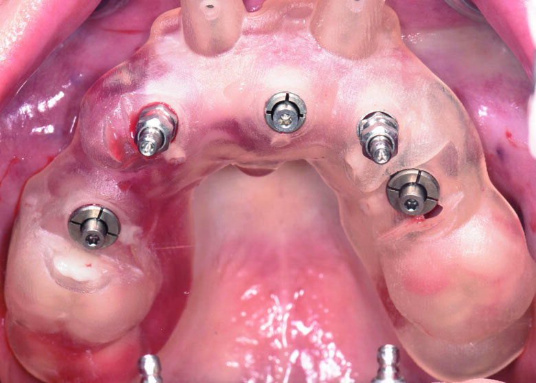 Fig 21. Fully-guided surgery was performed using Nobel Active