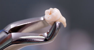 Studie belegt: Diabetes verursacht Zahnverlust