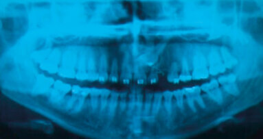 La terapia implantare, opzione terapeutica  per un canino incluso e il mantenimento  con approccio tailor-made: case report