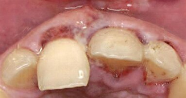 Augmentacja tkanek miękkich w strefie estetycznej za pomocą wielu warstw membrany kolagenowej