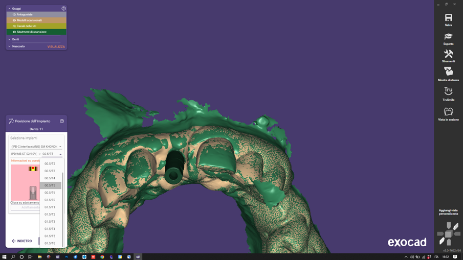 Fig. 4_La libreria con valori incrementali degli STL permette di correggere le aberrazioni luminose esaltando le già ottime performance di scanbody in materiali ibridi come Titanio/Peek.