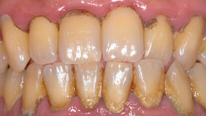 Nuovo approccio al protocollo di full-mouth disinfection