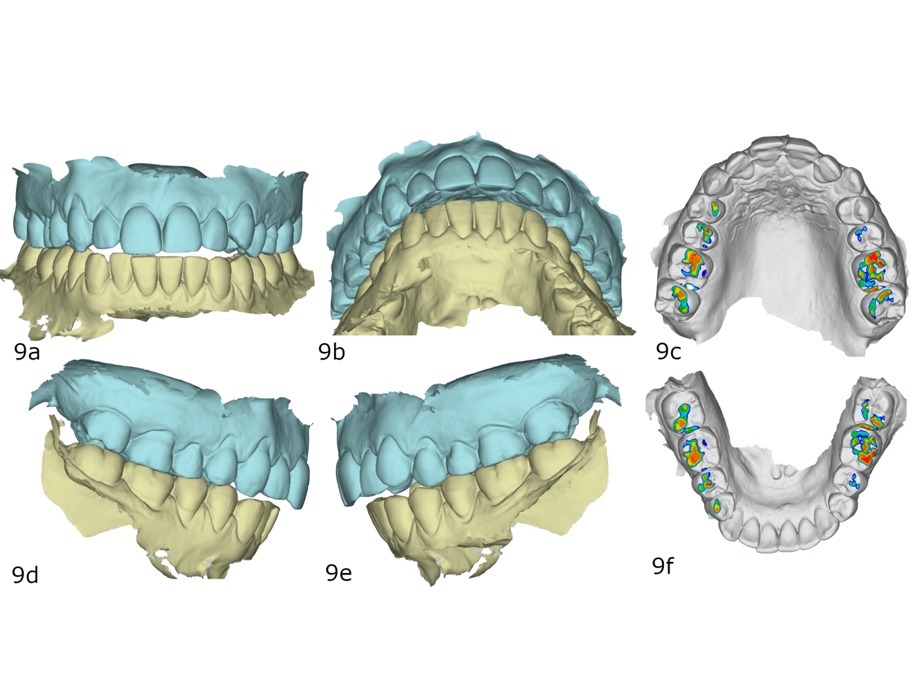 Figs. 9a–f: (a) Frontal view. (b) Overjet view. (c) Left lateral view. (d) Upper oclussal view. (e) Right lateral view. (f) Lower oclussal view.