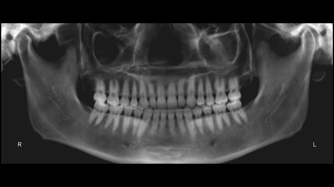 Fig. 37: Pretreatment panoramic radiograph.
