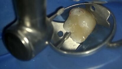 Laserowo wspomagane pokrycie bezpośrednie miazgi – opis przypadku