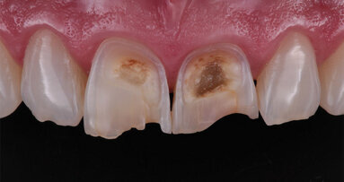 Solving aesthetic issues in the anterior  region with composite – Clinical Case