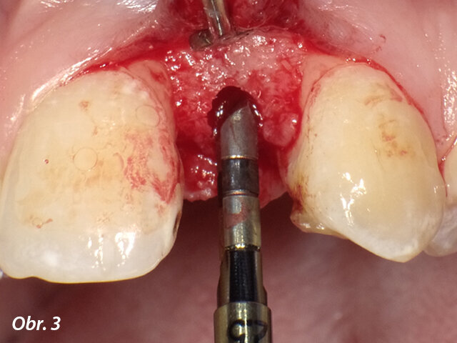 K rozšíření osteotomie předem preparované vysokorychlostním pilotní vrtákem se použije ruční rozšiřovač o průměru 2,5 mm.