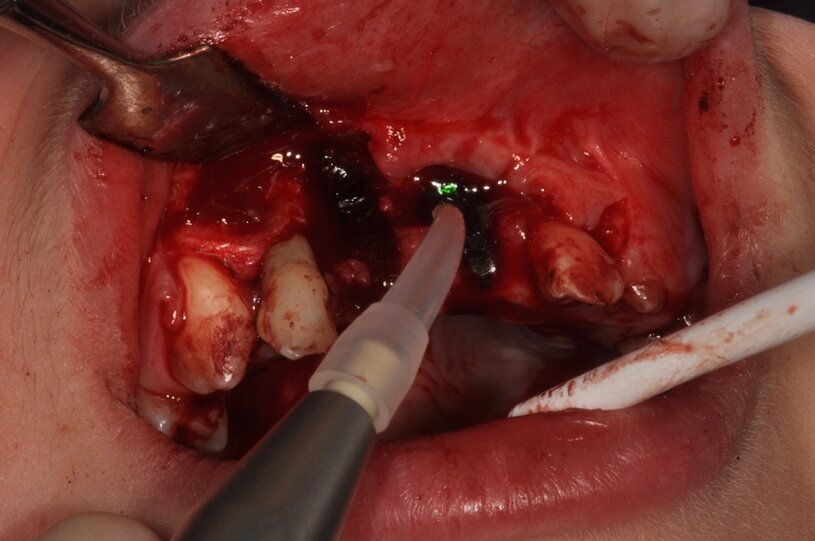 Ryc. 5_Stabilizacja skrzepu laserem Nd:YAG.