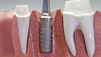 Strom soll Implantate von Bakterien befreien