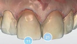 Afbeelding 7: Na het geven van de anesthesie werd de try-in gescand voor de zogenaamde biocopy.