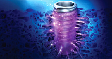 TS SOI gains ground in the European implant market