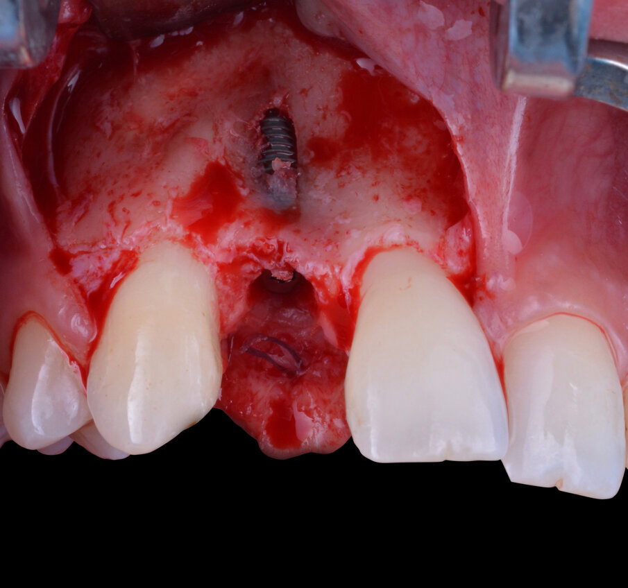 Fig. 6 - Impianto endo-osseo in situ e dettaglio della fenestrazione vestibolare.